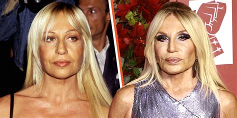 donatella versace before after surgery|donatella versace face what happened.